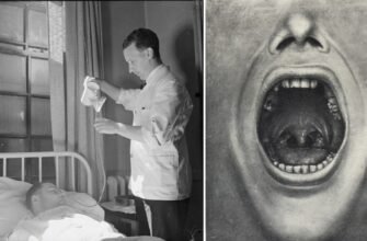 Smulsul dinților, o formă de terapie psihiatrică? Henry Cotton a ucis sute de pacienți crezând această teorie