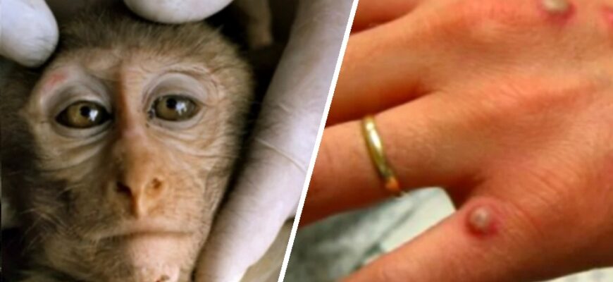 in republica moldova nu a fost inregistrat niciun caz de variola a maimutei