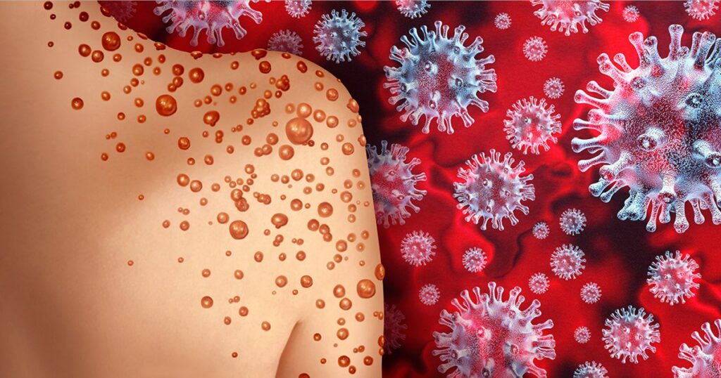 Variola maimuței: Simptomele primelor cazuri europene diferă de cazurile africane 1 monkeypox