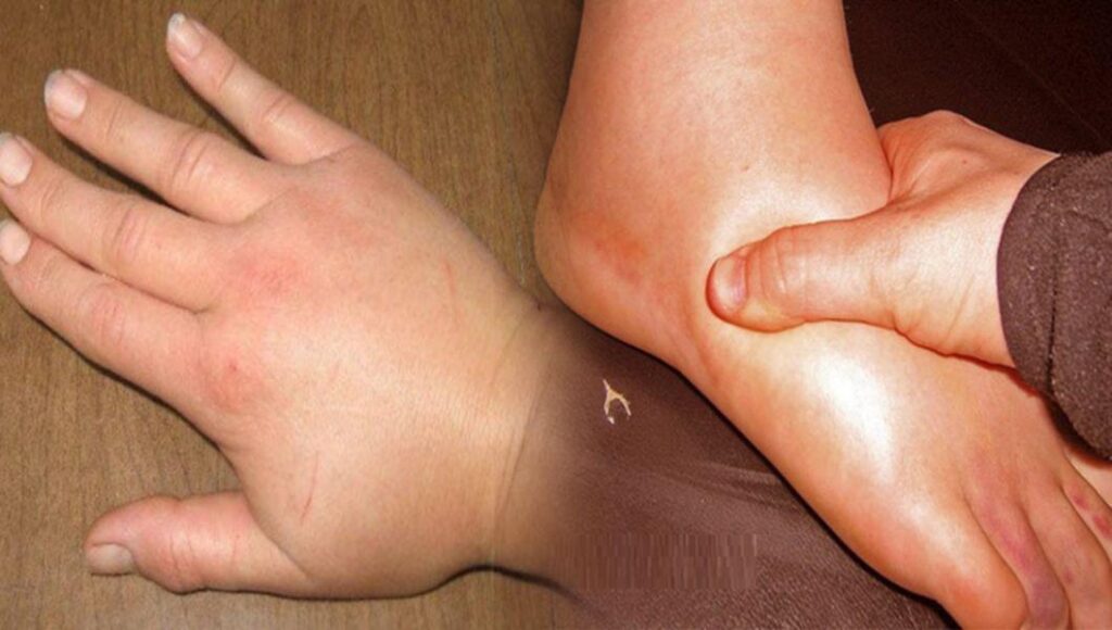 retentie de apa mare