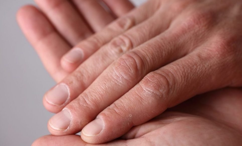Ficat bolnav: Semnul de pe palme care ar putea arăta că e ceva în neregulă