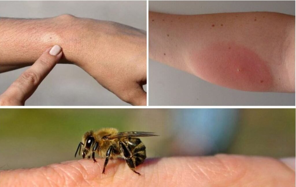 IMSP CNAMUP atenționează: Crește numărul de reacții alergice grave la înțepături de insecte 1 IMSP CNAMUP atenționează: Crește numărul de reacții alergice grave la înțepături de insecte