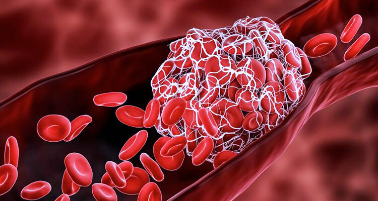 bautura care reduce formarea cheagurilor de sange in organism