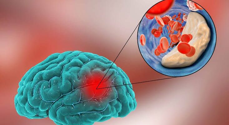 accident vascular cerebral