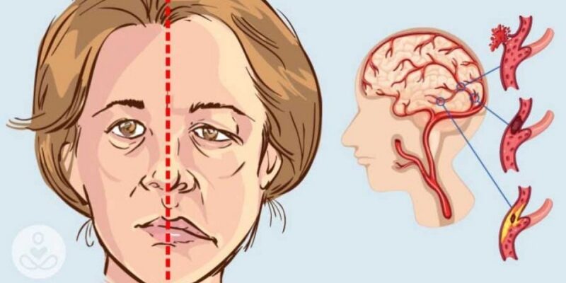 accident vascular cerebral simptome