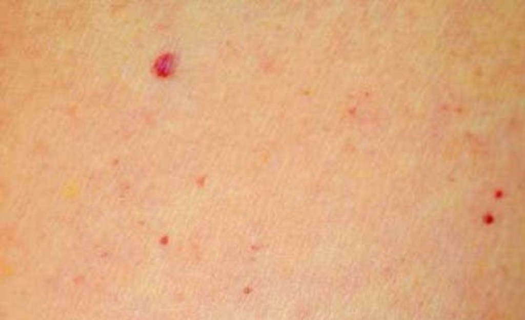 Când punctele roșii de pe corp, ca niște alunițe, reprezintă o problemă de sănătate serioasă 1 screenshot 1 11