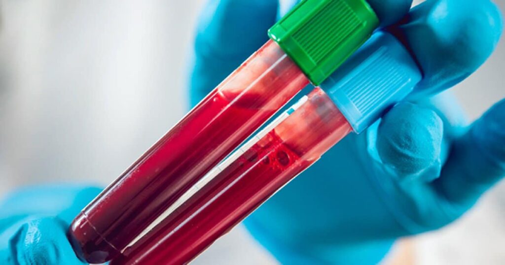 Ce să NU faceți înainte de analizele de sânge. Aceste lucruri ar putea influența rezultatele 1 teste de sange