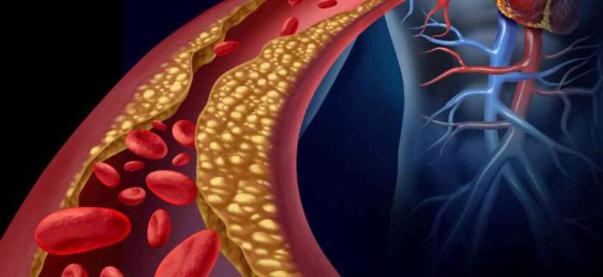 bolile pe care le poti face in functie de cifra colesterol