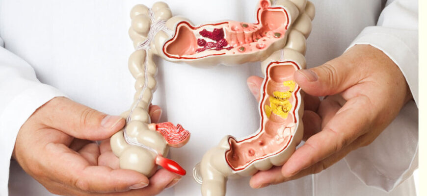 sindromul de colon iritabil