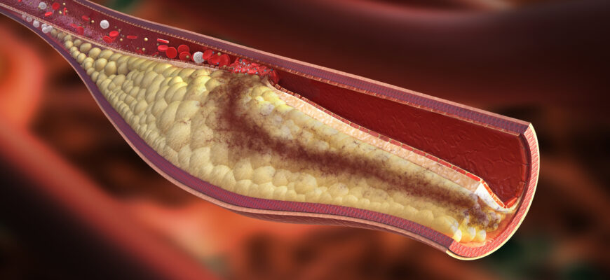 coronarografia cum se face
