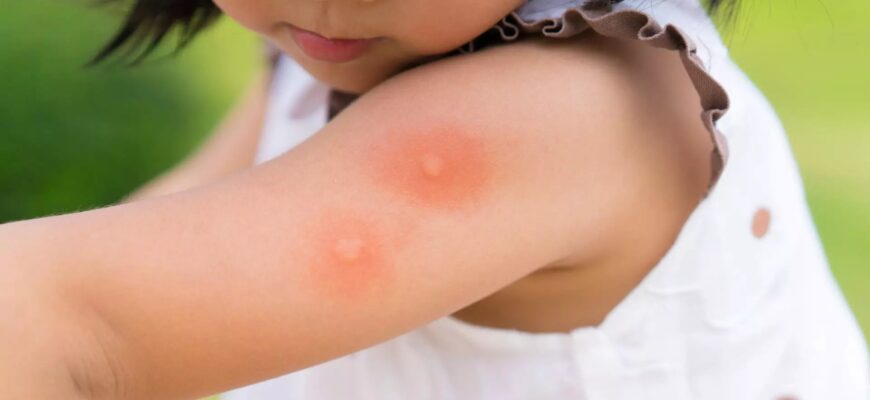 alergic la muscaturile de tantari