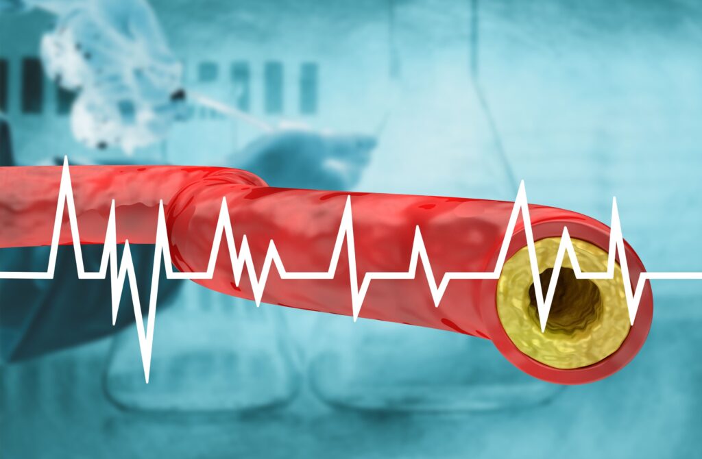 riscurile de infarct miocardic