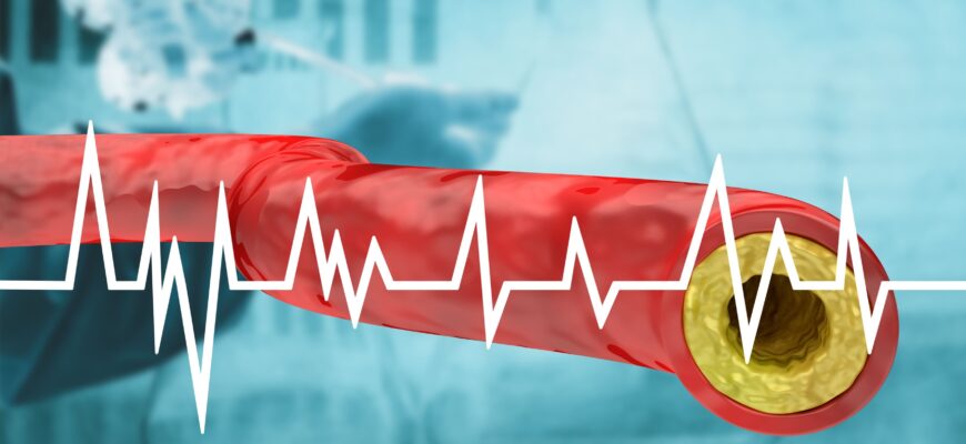 riscurile de infarct miocardic