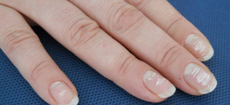 striatiile orizontale pe unghii