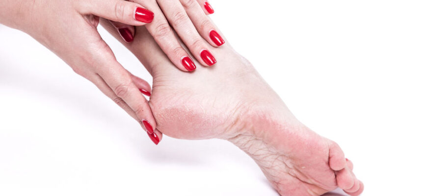 de ce pielea de pe calcaie devine aspra