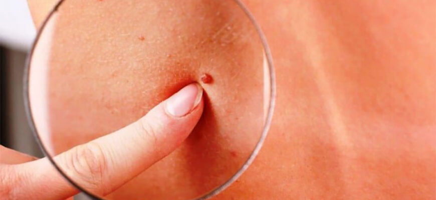 tratament naturist pentru papiloame