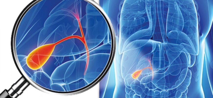 tratament naturist pentru pietre la fiere