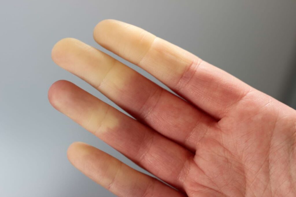 fenomenul raynaud