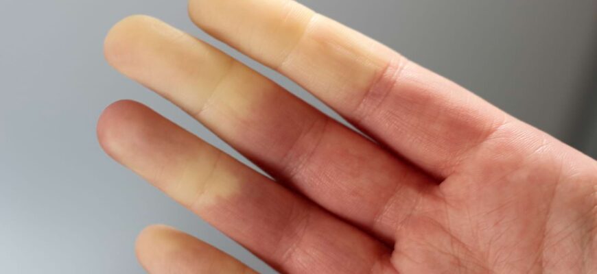 fenomenul raynaud