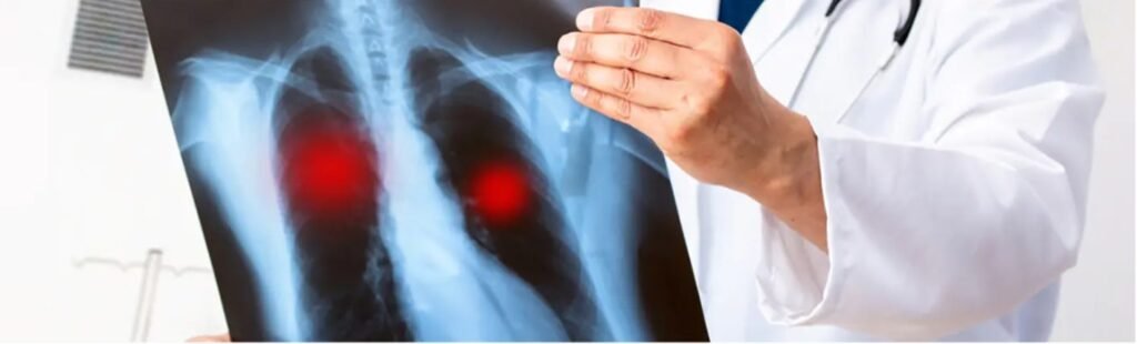 Ce este tuberculoza? Cauze, simptome și factorii  de risc pentru a dezvolta această infecție