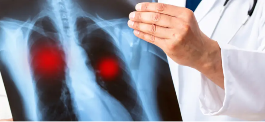 tuberculoza sau tbc ul numita in trecut oftica 1