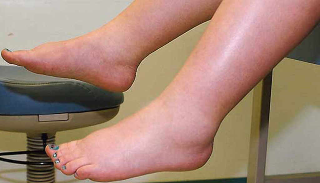 anasarca este un tip sever de edem