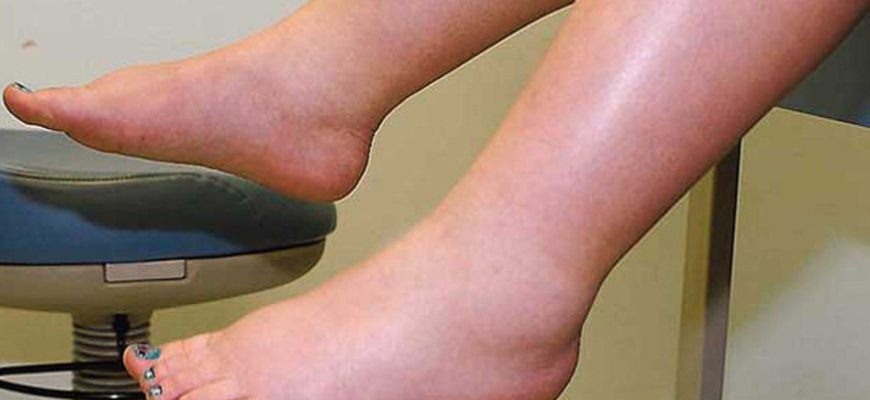 anasarca este un tip sever de edem