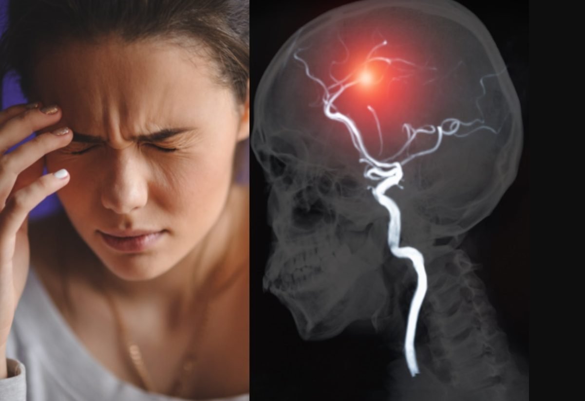 Accidentul ischemic tranzitor (AIT), avertisment serios pentru accidentul vascular cerebral (AVC). Diferențe și asemănări