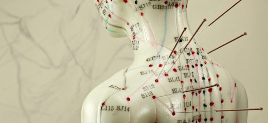 acupunctura este o forma de terapie alternativa
