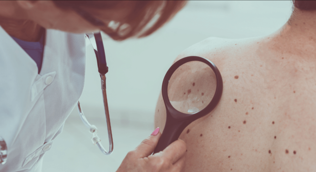 Cancerul de piele, prevenire și recomandări date de terapeuții chinezi 1 cancerul de piele