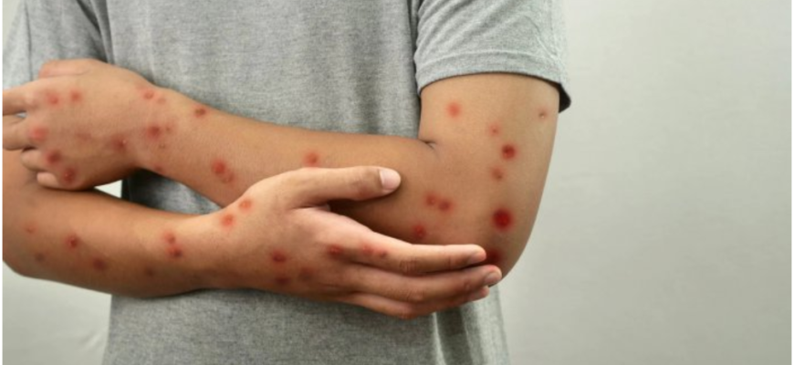 cazuri suspecte de rujeola