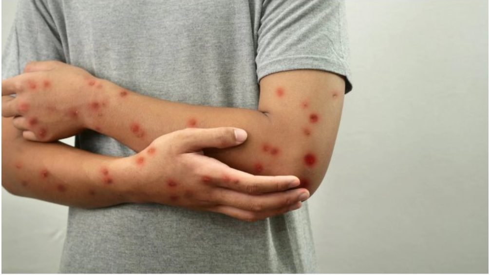 Într-o săptămână, două cazuri suspecte de rujeolă au fost înregistrate în capitală