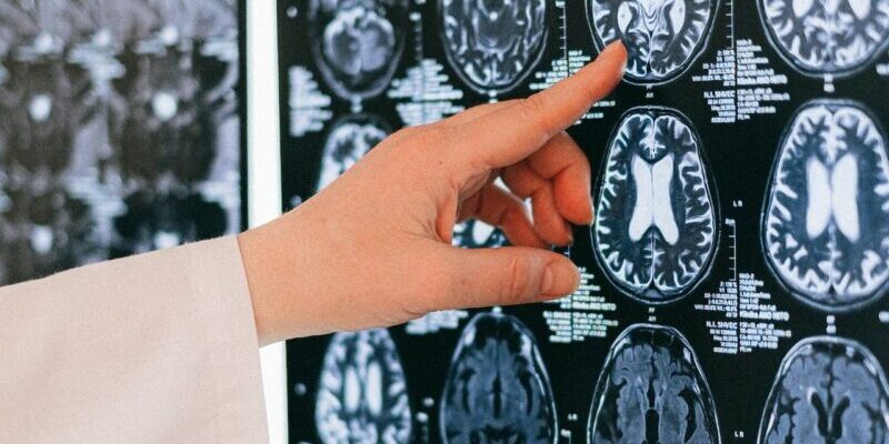 creier radiografie tesut cerebral rmn tomograf e1701797034546