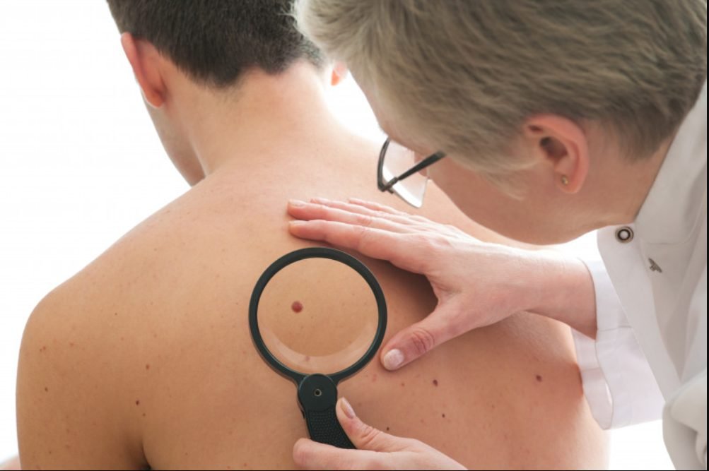 Cancerul de piele, prevenire și recomandări date de terapeuții chinezi
