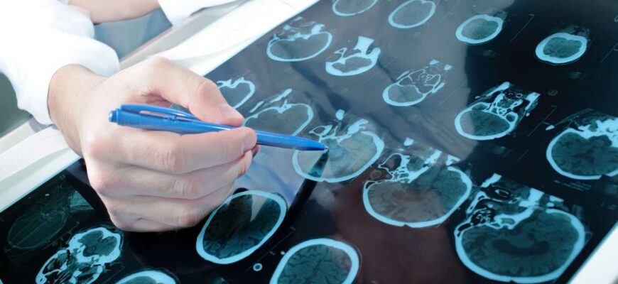 Ministerul Sănătății lansează Campania națională de comunicare pentru recunoașterea semnelor accidentului vascular cerebral (AVC) 1 recunoasterea semnelor accidentului vascular cerebral